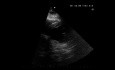 Cuestionario de ecocardiografía. ¿Alguna anormalidad en la función sistólica del ventrículo izquierdo?