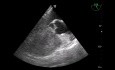 Un caso raro (quiz) de ecocardiografía transesofágica