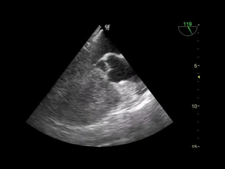 Un caso raro (quiz) de ecocardiografía transesofágica