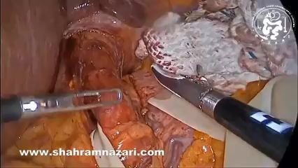 Perforación de la mucosa acalásica: reparación de la perforación detectada intraoperatoriamente