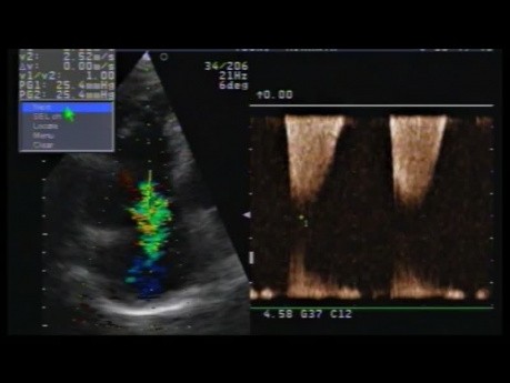 Miocardiopatía ventricular derecha arritmogénica.. ECG y ecocardiografía