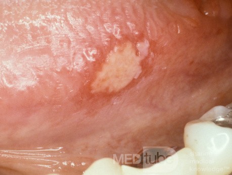 Úlcera aftosa