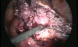 Extirpación de un embarazo abdominal heterotrófico por laparoscopia