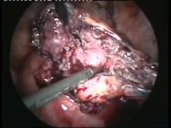 Extirpación de un embarazo abdominal heterotrófico por laparoscopia