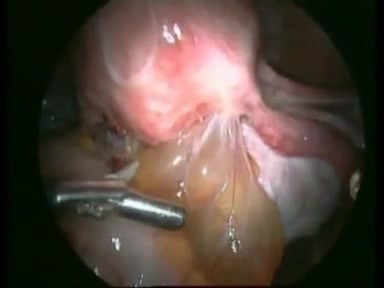 Excisión del nódulo endometriósico rectovaginal a través de técnica laparoscópica