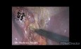 Colecistectomía laparoscópica después de microperforación durante CPRE / Arteria hepática derecha reemplazada