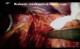 Esofagectomía transhiatal laparoscópica robótica
