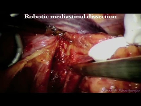Esofagectomía transhiatal laparoscópica robótica