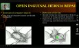 Reparación abierta de hernia inguinal