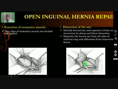 Reparación abierta de hernia inguinal