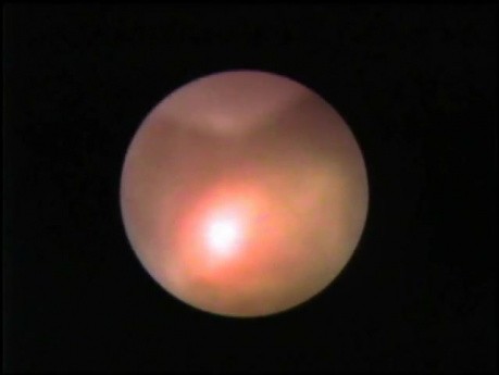 Ureterolitotricia