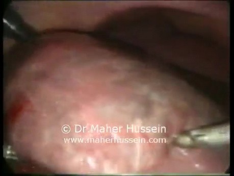 Resección de segmento VI del hígado - abordaje laparoscópico
