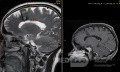 Estirpación de cavernoma subcortical 