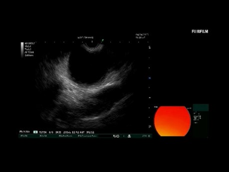 Cistogastrostomía guiada por ecografía endoscópica