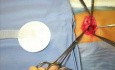 Vídeo de reparación de hernia umbilical