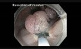 Canal de colonoscopia - RME de un pólipo rectal gigante