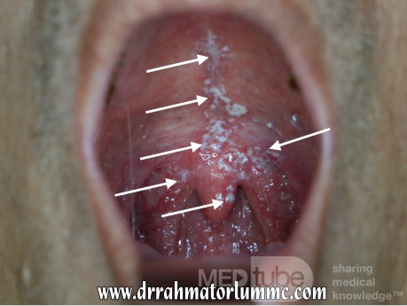 Candidiasis oral