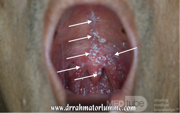 Candidiasis oral