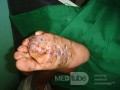 Micetoma en el pie izquierdo