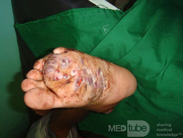 Micetoma en el pie izquierdo
