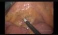 Hemicolectomía laparoscópica izquierda, excisión mesocólica completa para carcinoma de colon sigmoide
