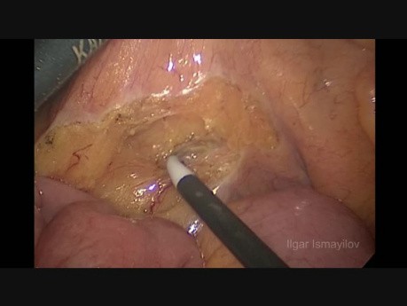 Hemicolectomía laparoscópica izquierda, excisión mesocólica completa para carcinoma de colon sigmoide