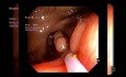Resección endoscópica de la mucosa (REM) de una lesión periapendicular después de una incisión mucosa circunferencial parcial