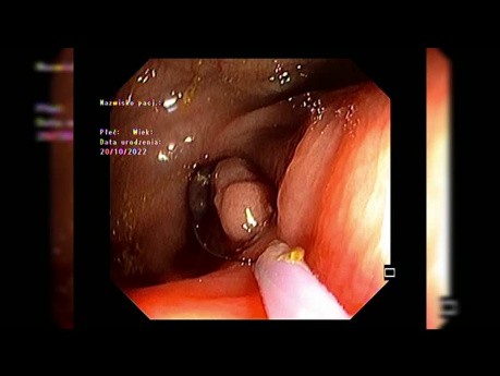 Resección endoscópica de la mucosa (REM) de una lesión periapendicular después de una incisión mucosa circunferencial parcial