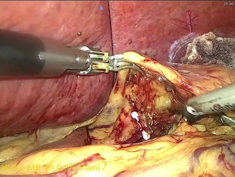 Gastrectomía en cuña lapeada con sutura intracorpórea para GIST en curvatura menor