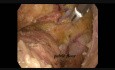 Resección anterior baja laparoscópica para el cáncer de recto