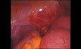 Urgencias ginecologicas abdomen agudo adenocarcinoma ileon 2002