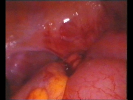 Urgencias ginecologicas abdomen agudo adenocarcinoma ileon 2002