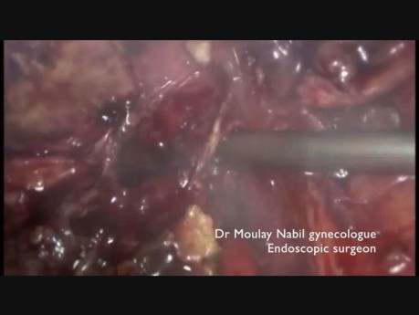 Afeitado rectal y ureterólisis para la endometriosis infiltrante profunda