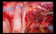 Lobectomía en doble manga (double sleeve) intrapericárdico uniportal VATS con pinza vascular proximal