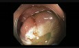 Colonoscopia - resección mucosa endoscópica (RME) del colon trasnverso - cambio de colocación del lazo quirúrgico