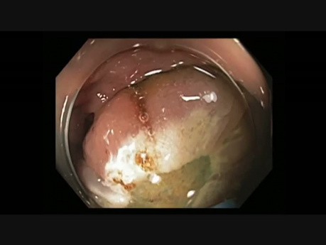 Colonoscopia - resección mucosa endoscópica (RME) del colon trasnverso - cambio de colocación del lazo quirúrgico