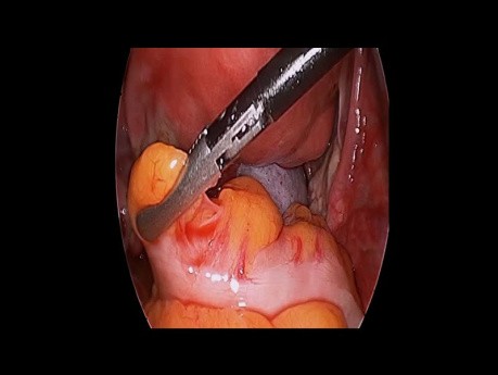 Abdomen Agudo Torsion Teratoma