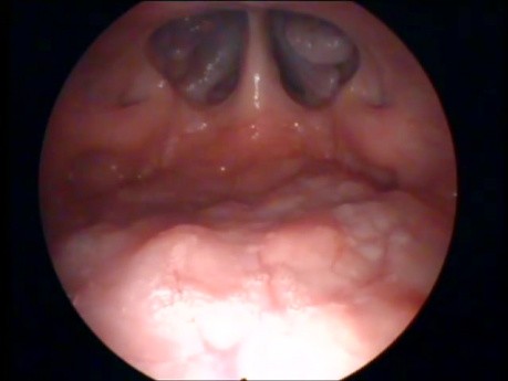 Técnica de nasofaringoscopia transoral: la visión de la nasofaringe.