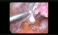 Cirugía laparoscópica para el quiste paraovárico