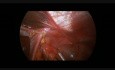 Procedimiento laparoscópico de Ladd en una etapa, apendicectomía y fundoplicatura de Nissen en un niño de 7 años