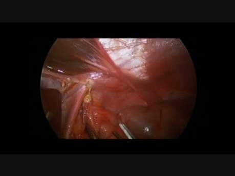 Procedimiento laparoscópico de Ladd en una etapa, apendicectomía y fundoplicatura de Nissen en un niño de 7 años