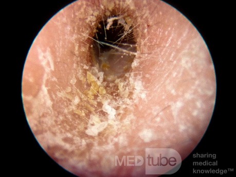 Eczema del conducto externo