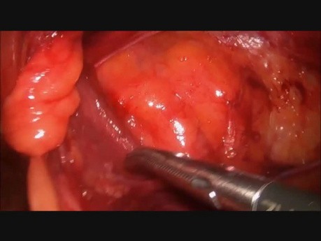 Operación de la hernia inguinal por el método TAPP usando una malla ProGrip