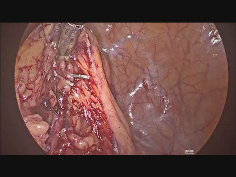 Colectomía Sigmoidea Laparoscópica para Diverticulitis