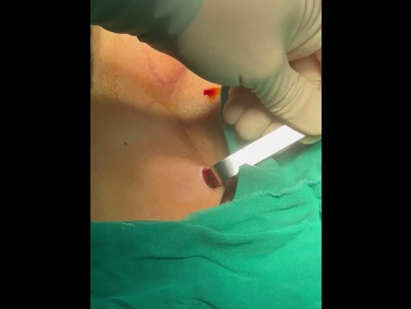 Cirugía endoscópica de tiroides transsubclavia de doble puerto (parte 0)