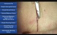 Punto interrumpido simple - técnicas de sutura