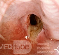 Adenocarcinoma de paladar