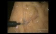 Resección anterior laparoscópica muy baja para cáncer rectal supraanal