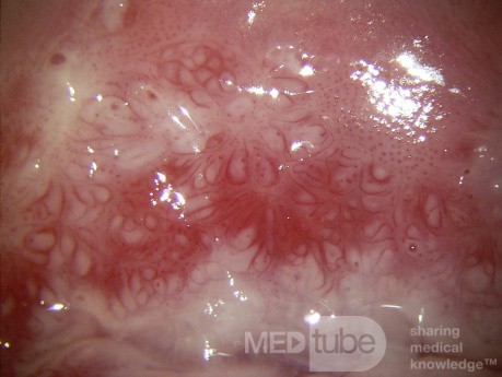 Colposcopia - CIN3