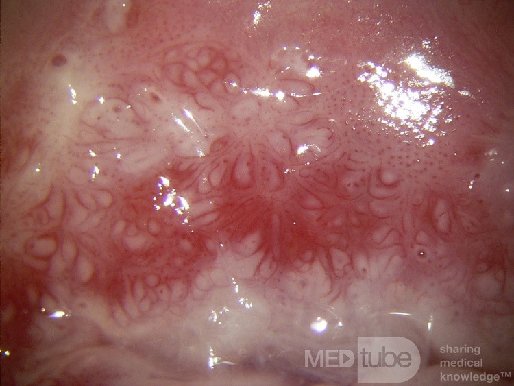Colposcopia - CIN3